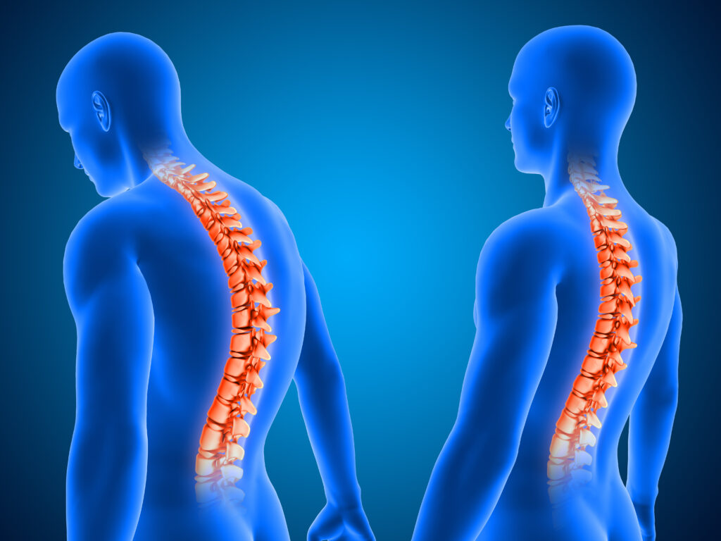 This image has an empty alt attribute; its file name is 3d-render-showing-correct-poor-posture-with-spine-highlighted-1-1024x768.jpg